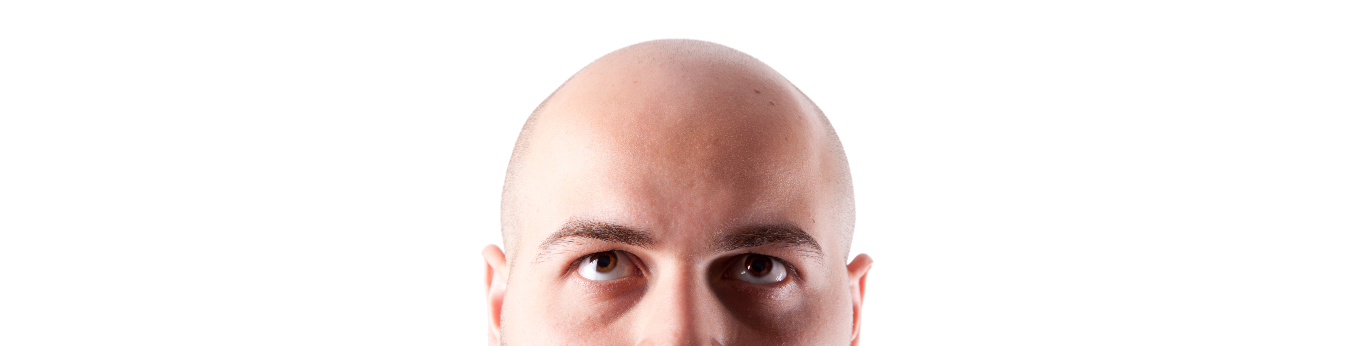 Was tun bei erblich bedingtem Haarausfall?